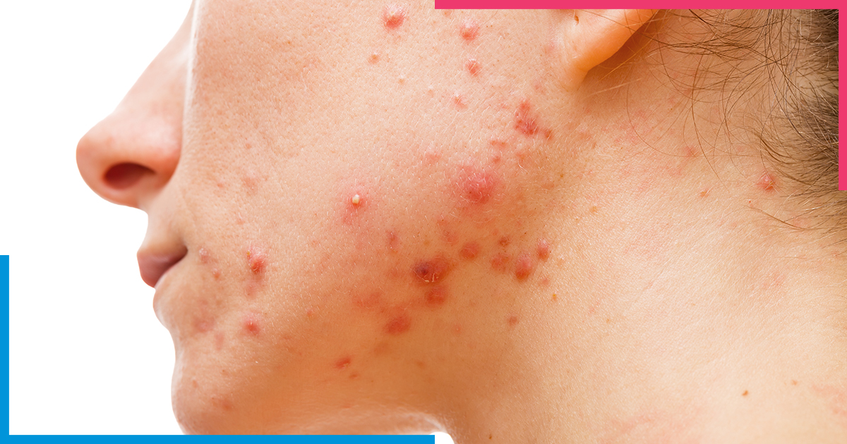 Nodule-skiinaceclinic