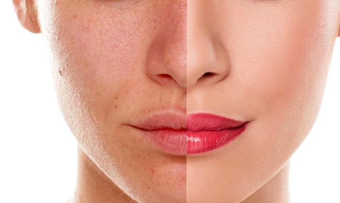 Pigmentation Treatment